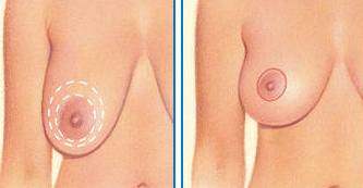 Breast Lift Surgery